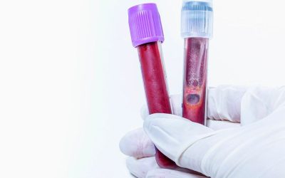 Kako se pripremiti za laboratorijsko vađenje krvi
